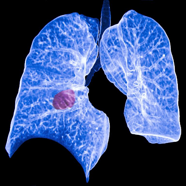 cancer pulmonar, pulmonar primar, cancer pulmonar primar, cancerul pulmonar
