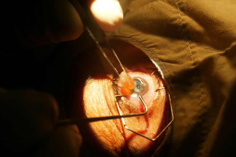 cataractă laser, chirurgia cataractă, chirurgia cataractă laser, operația cataractă, când este