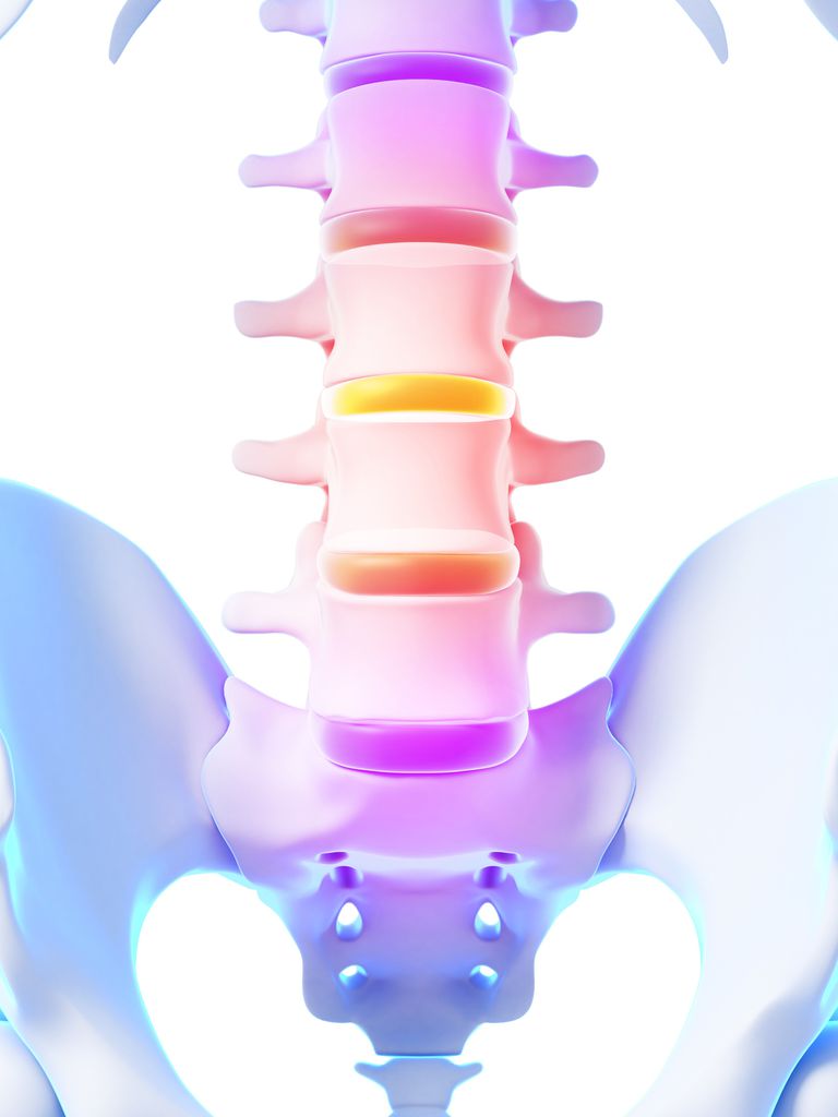 coloanei vertebrale, discului este, care sunt, coloana vertebrală, fuziune spinală