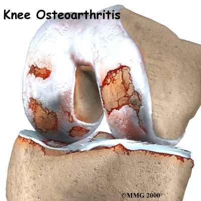 osteoartrita genunchiului, aceste tratamente, chirurgi ortopedici, aceste linii, Aceste linii directoare