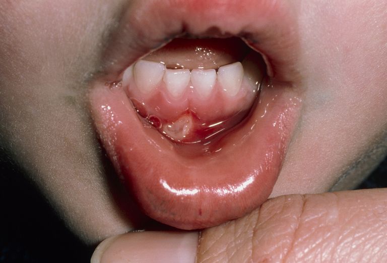nivelul gurii, recurente nivelul, recurente nivelul gurii, copilului dumneavoastră, stomatită aftoasă, Ulcere recurente