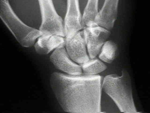 fractură scaphoidă, unei fracturi, degetului mare, încheieturii mâinii, afara poziției