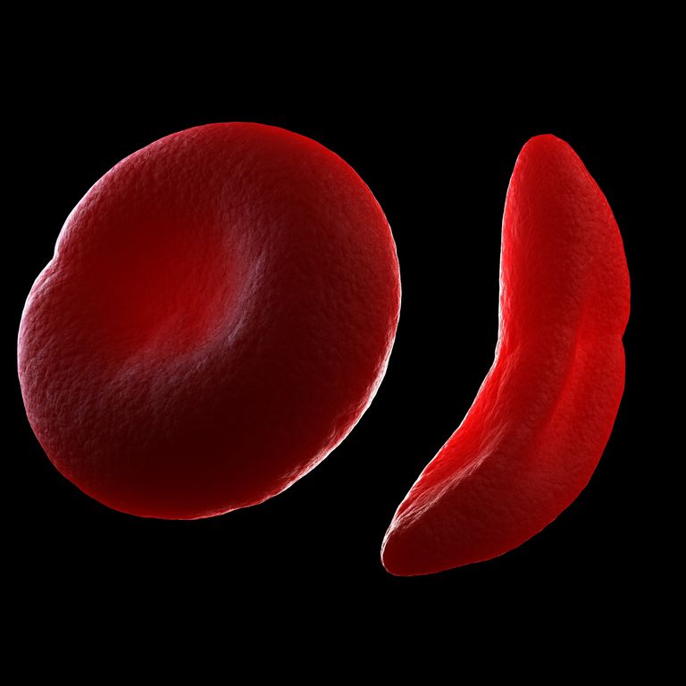 anemia celulelor, celulelor secerătoare, Hidroxieurea este, roșii sânge, tratamentul hidroxiuree, activitățile zilnice