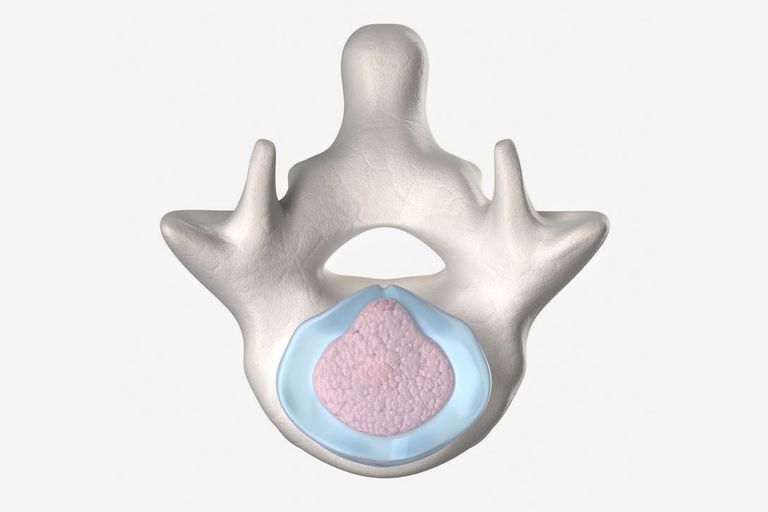 coloanei vertebrale, hernie disc, disc herniat, medicul dumneavoastră, coloana vertebrală, este adesea