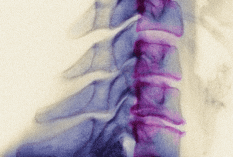 musculară spinală, atrofie musculară, atrofie musculară spinală, august 2006