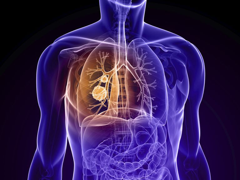 cancer pulmonar, cancerul pulmonar, cancerului pulmonar, doilea cancer, pulmonar este