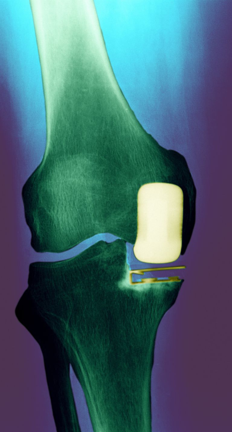 articulației genunchiului, genunchiului este, dureri genunchi, înlocuire genunchiului, Înlocuirea parțială