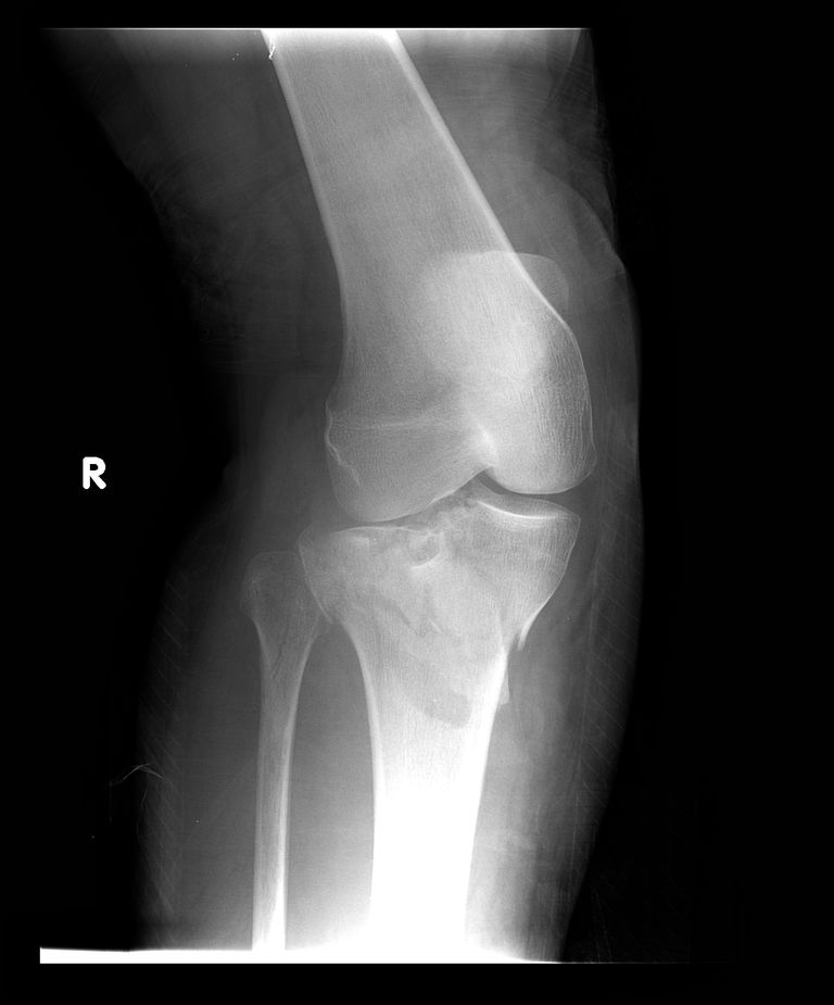 platoului tibial, articulației genunchiului, bine aliniate, fracturilor platoului, fracturilor platoului tibial, intervenție chirurgicală