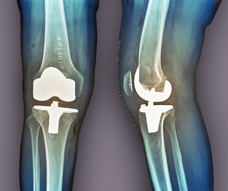 parțială genunchiului, Înlocuirea parțială, înlocuirea parțială genunchiului, totală genunchiului, pentru înlocuirea, pentru înlocuirea parțială