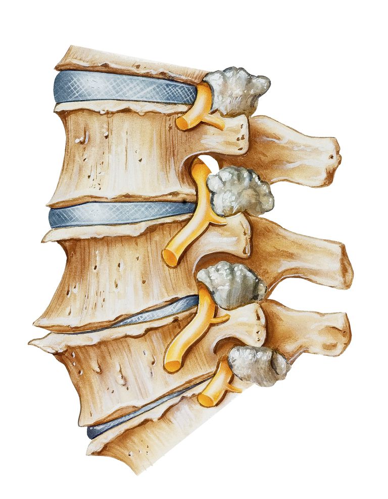 apropiat disc, coloana vertebrală, coloanei vertebrale, vertebrale lombare, coloanei vertebrale lombare