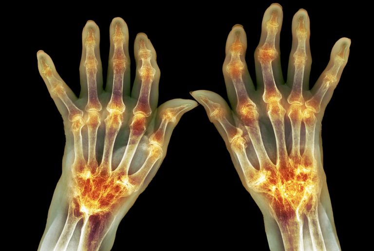 artritei reumatoide, artritei reumatoide severe, reumatoide severe, artritei reumatoide sunt, care trăit, care trăit boala