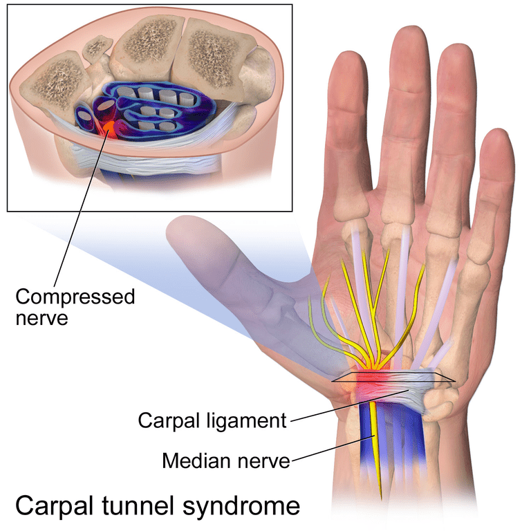 tunel carpian, sindromului tunel, sindromului tunel carpian, tunelului carpian, nervului median
