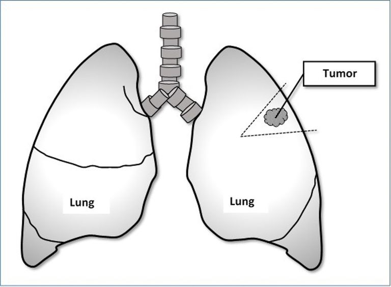 cancer pulmonar, rezecție clinică, rezecție pană, persoanele care, cancerul pulmonar, cancerului pulmonar