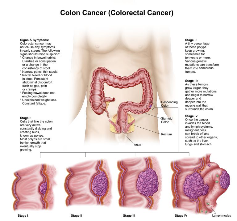 peretelui colonului, ganglioni limfatici, Cancerul este, colon este, afectează între
