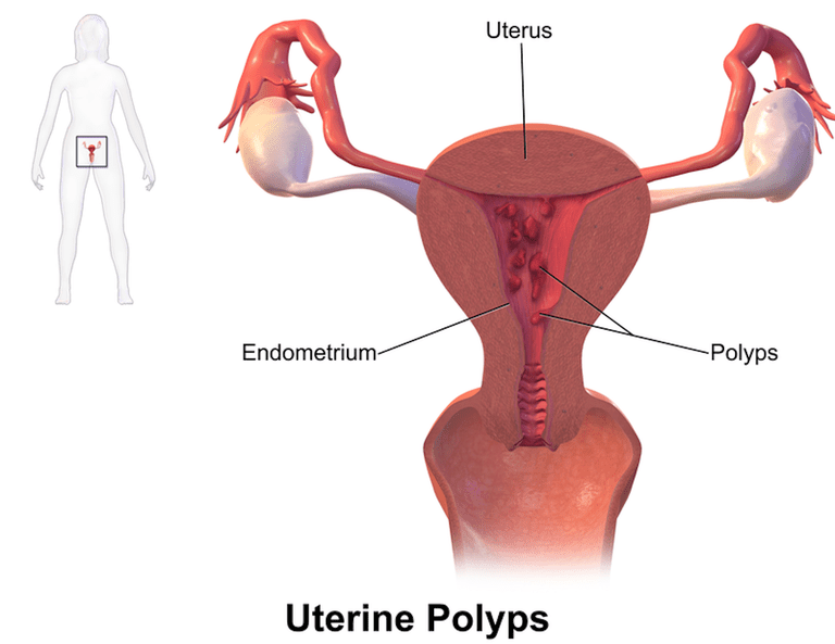 polipilor uterini, femeile care, uterini sunt, atunci când, care utilizează, cavitatea uterină