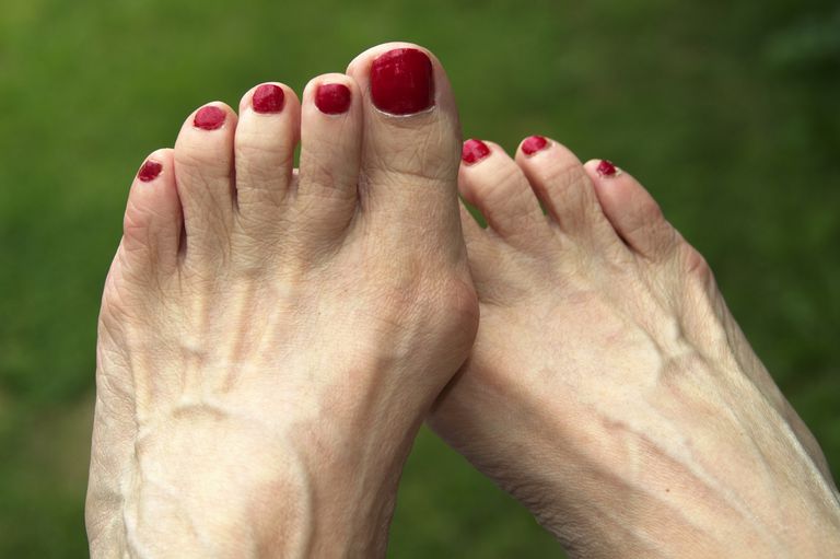 degetele picioare, dezvolta bunion, este singura, încălțăminte occidentală, istoric familial