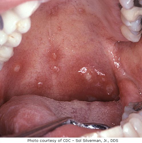 herpes simplex, Această imagine prezintă, imagine prezintă, infecție herpes, Această imagine