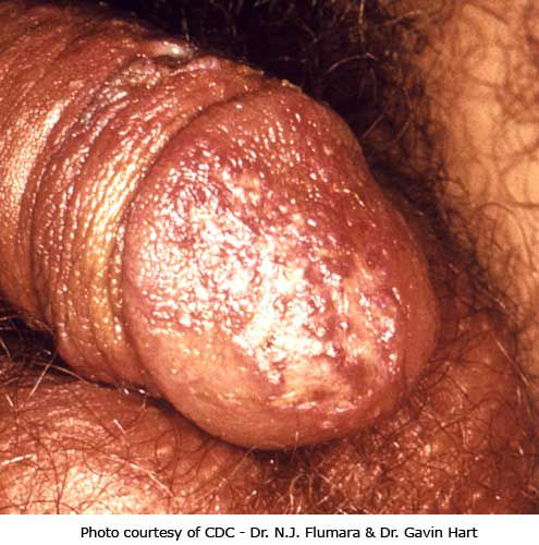 herpes simplex, Această imagine prezintă, imagine prezintă, infecție herpes, Această imagine