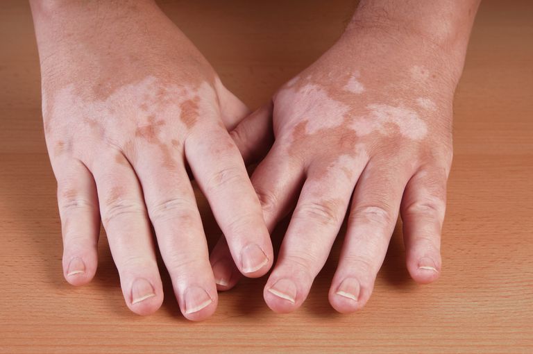 pentru vitiligo, vitiligo este, boli autoimune, zonele afectate, acest tratament