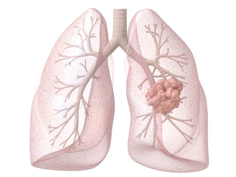 cancer pulmonar, cancerului pulmonar, cancerul pulmonar, pulmonar este, pentru cancerul