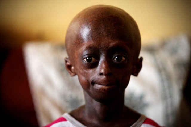 este neobișnuit, Hutchinson-Gilford progeria, progeria este, Sindromul Werner