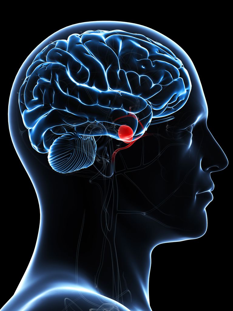 anevrism creierului, anevrisme cerebrale, anevrism cerebral, anevrismului cerebral