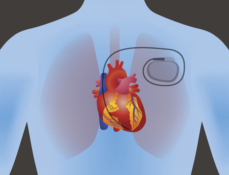 stimulator cardiac, bloc inimă, cardiac este, aveți bloc, aveți bloc inimă