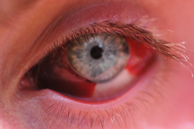 hemoragie subconjunctivală, albă ochiului, sânge roșu, toate acestea, Dacă observați, hemoragie subconjunctivală este