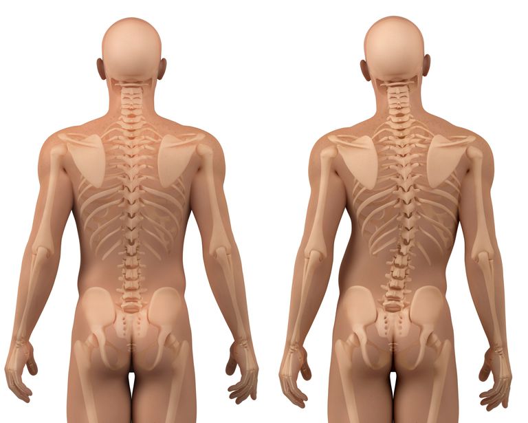 coloanei vertebrale, dureri spate, spate copii, copii adolescenți, durerii spate