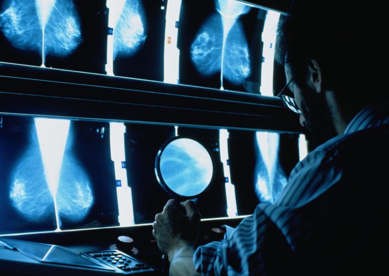 mamografie anuală, acestea dacă, care avut, care putea